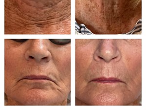 Before and after:
 3 Fotona Dynamis Laser 4D Facelift Treatments
